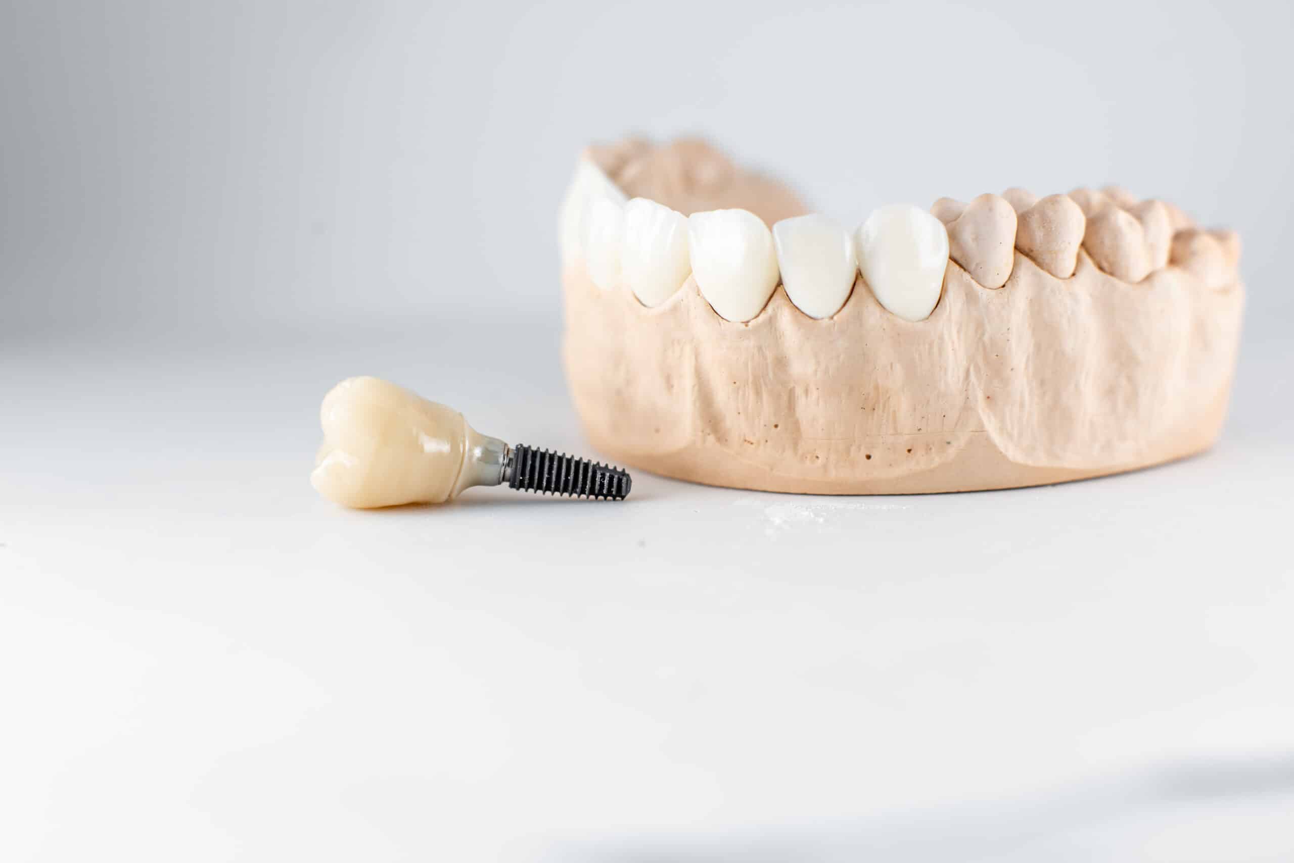 dental implant 1